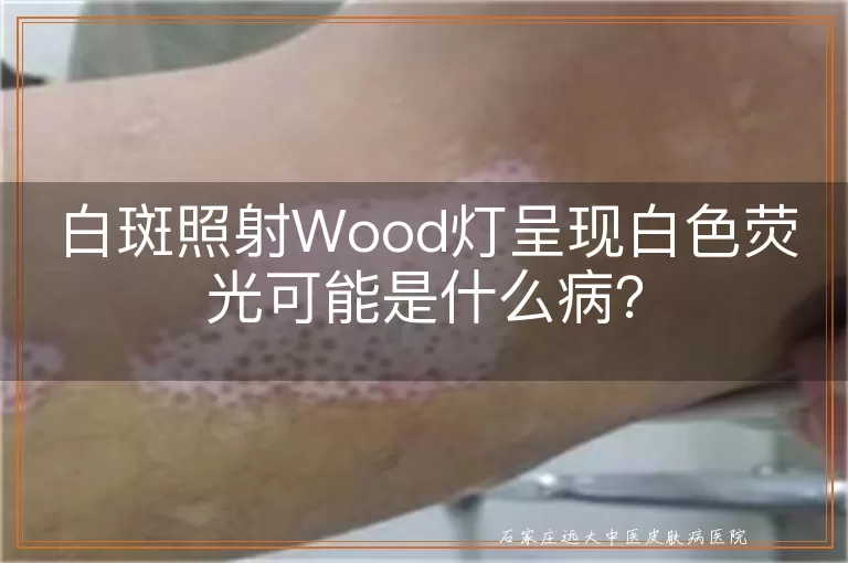 白斑照射Wood灯呈现白色荧光可能是什么病？
