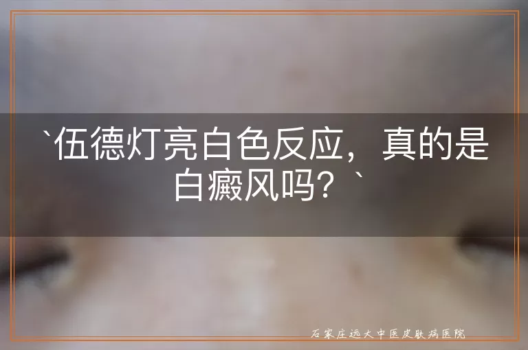 伍德灯亮白色反应，真的是白癜风吗？
