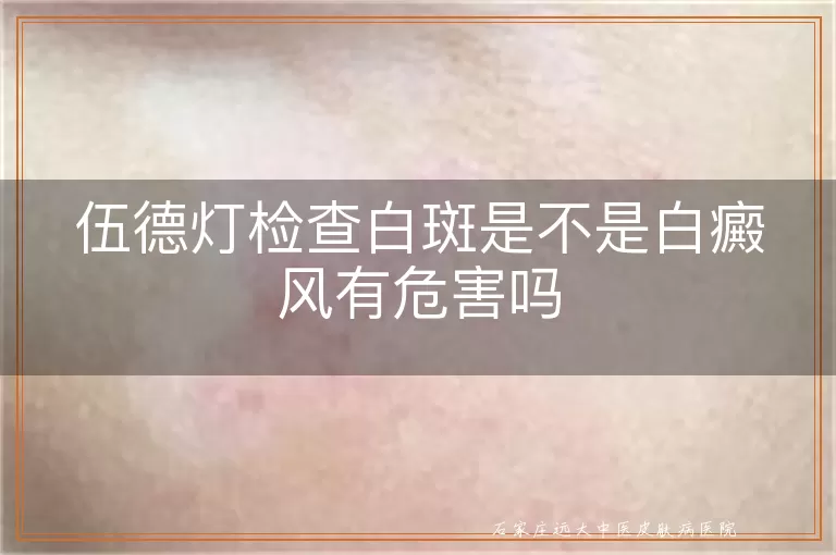 伍德灯检查白斑是不是白癜风有危害吗