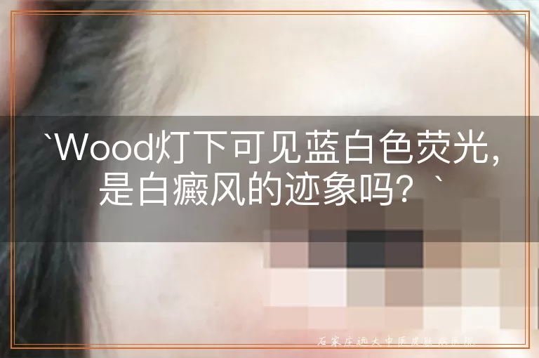 Wood灯下可见蓝白色荧光，是白癜风的迹象吗？