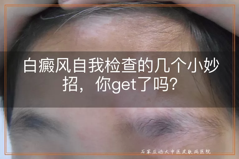 白癜风自我检查的几个小妙招，你get了吗？