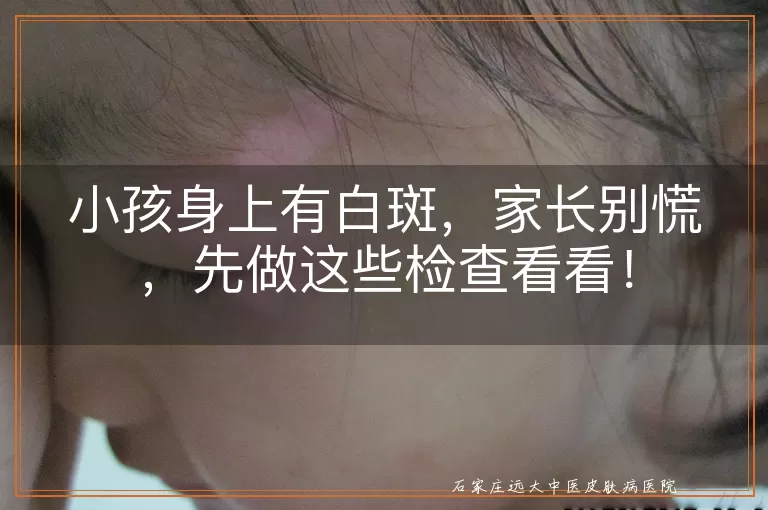 小孩身上有白斑，家长别慌，先做这些检查看看！