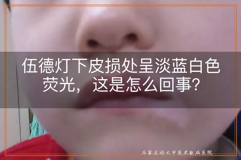 伍德灯下皮损处呈淡蓝白色荧光，这是怎么回事？