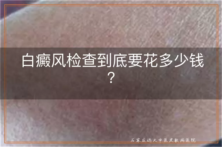 白癜风检查到底要花多少钱？