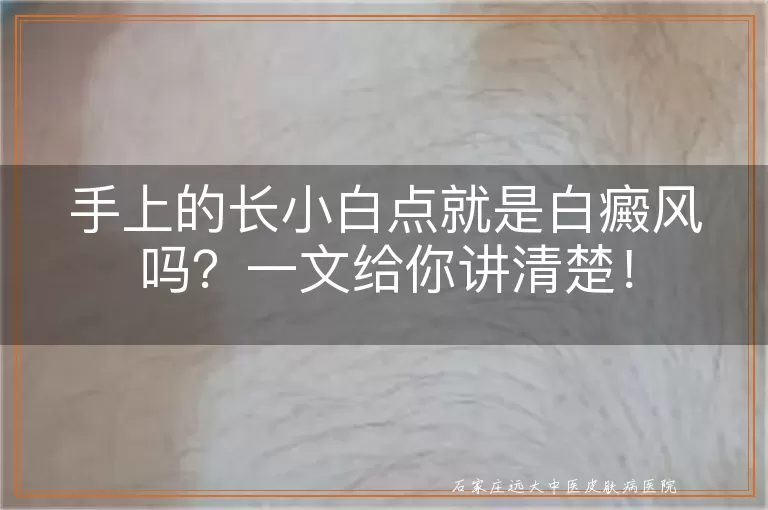 手上的长小白点就是白癜风吗？一文给你讲清楚！