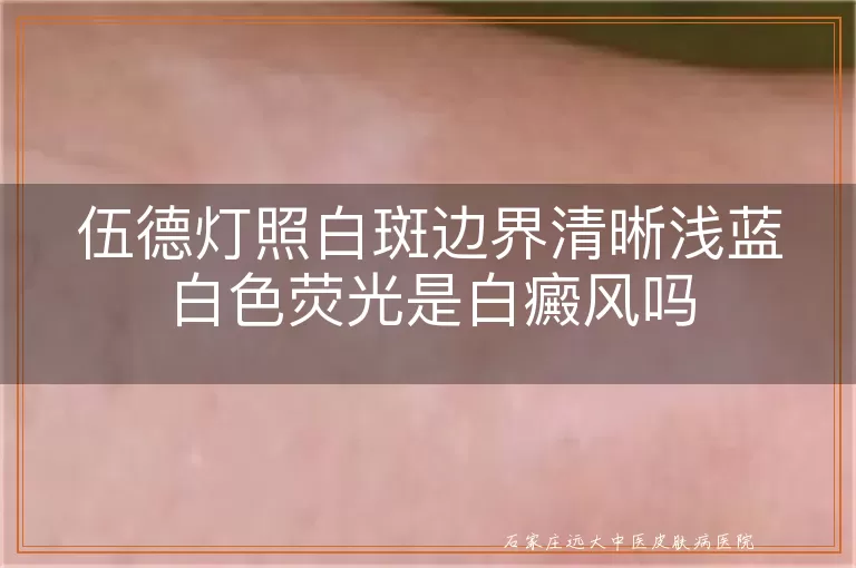 伍德灯照白斑边界清晰浅蓝白色荧光是白癜风吗