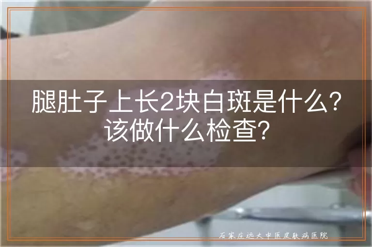 腿肚子上长2块白斑是什么？该做什么检查？