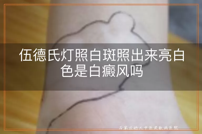伍德氏灯照白斑照出来亮白色是白癜风吗