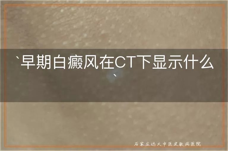 早期白癜风在CT下显示什么