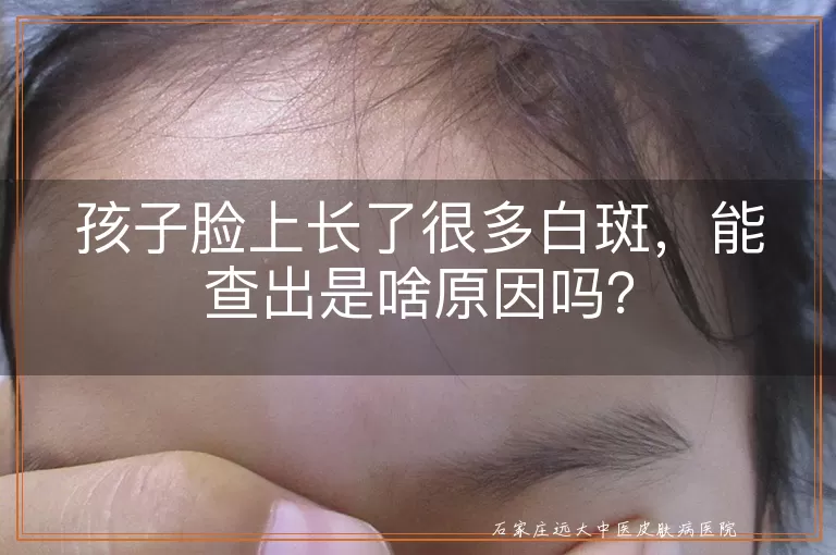 孩子脸上长了很多白斑，能查出是啥原因吗？
