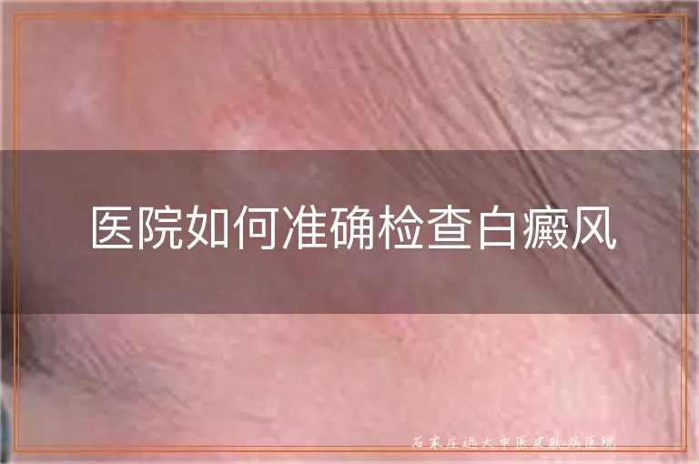 医院如何准确检查白癜风