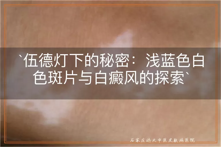 伍德灯下的秘密：浅蓝色白色斑片与白癜风的探索