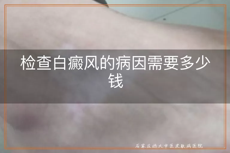 检查白癜风的病因需要多少钱