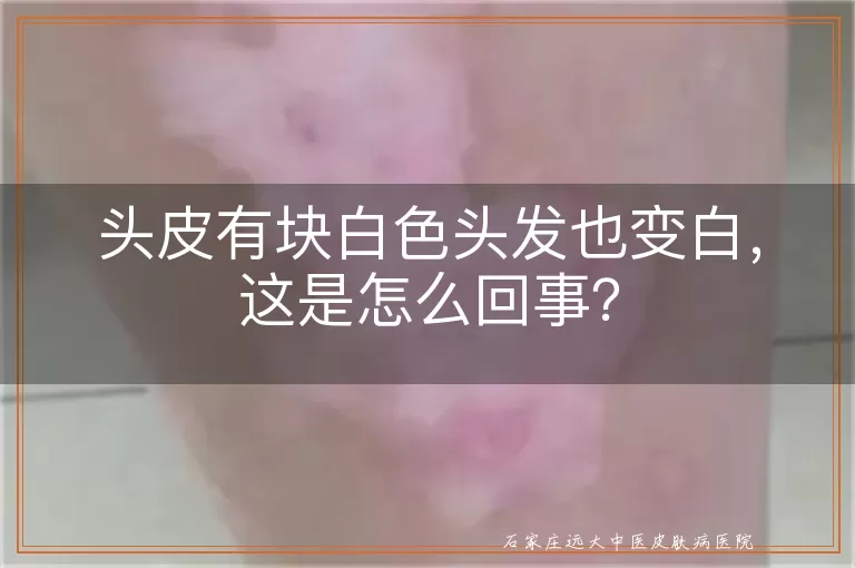 头皮有块白色头发也变白，这是怎么回事？