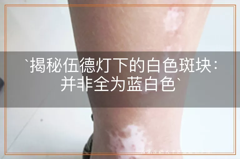 揭秘伍德灯下的白色斑块：并非全为蓝白色