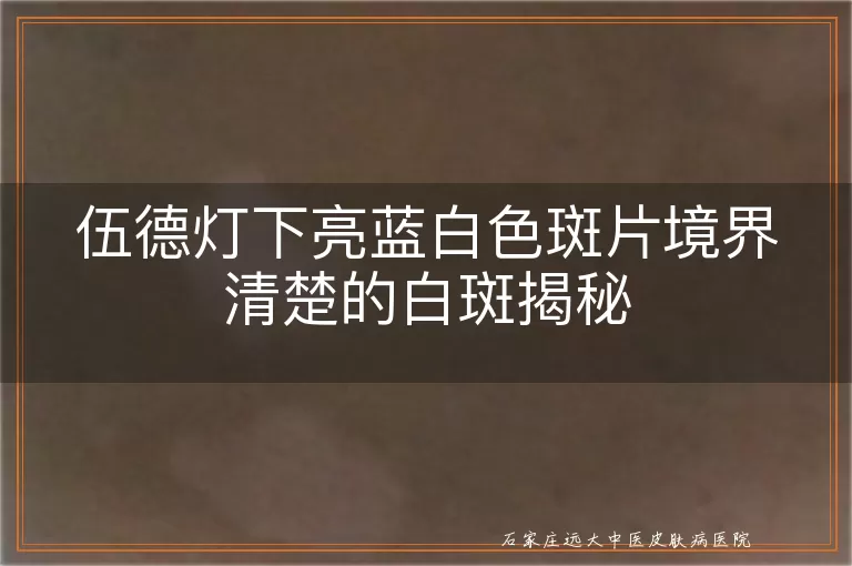 伍德灯下亮蓝白色斑片境界清楚的白斑揭秘