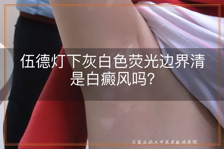 伍德灯下灰白色荧光边界清是白癜风吗？