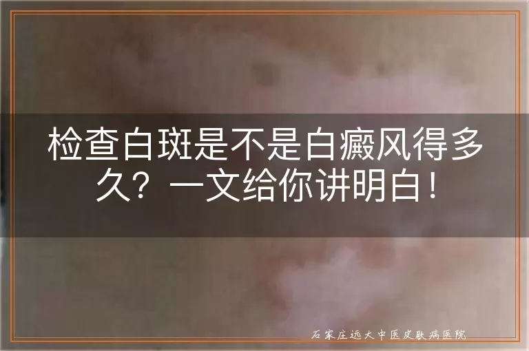 检查白斑是不是白癜风得多久？一文给你讲明白！
