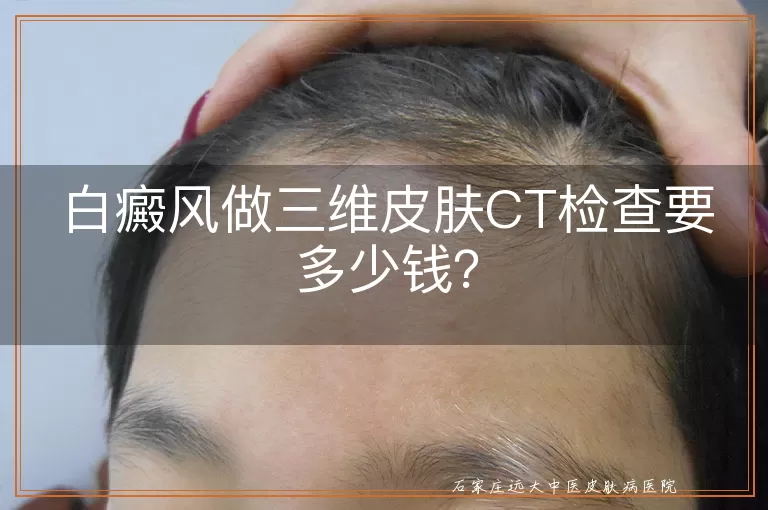 白癜风做三维皮肤CT检查要多少钱？