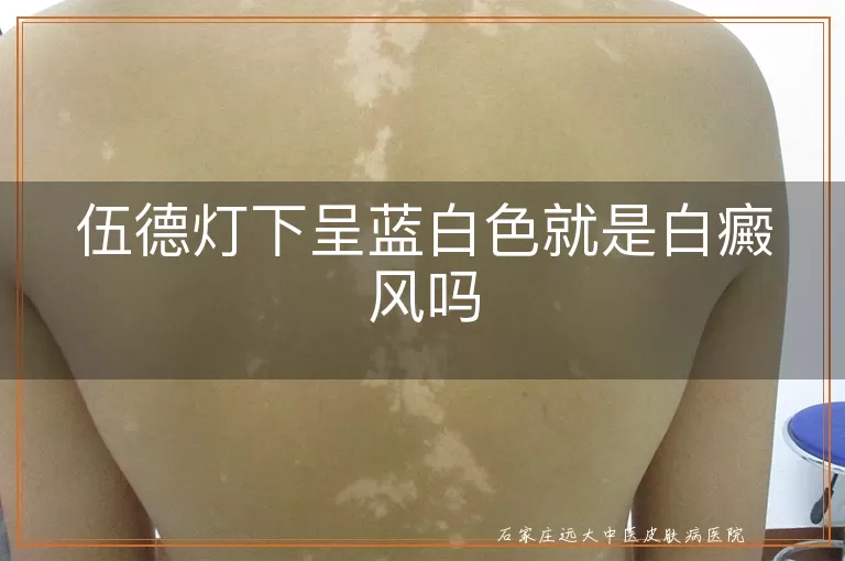 伍德灯下呈蓝白色就是白癜风吗