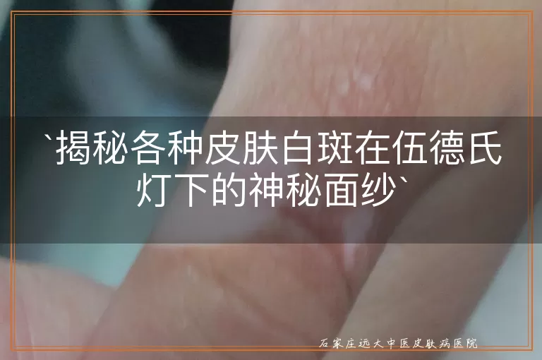 揭秘各种皮肤白斑在伍德氏灯下的神秘面纱