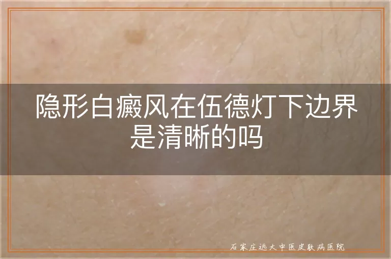 隐形白癜风在伍德灯下边界是清晰的吗