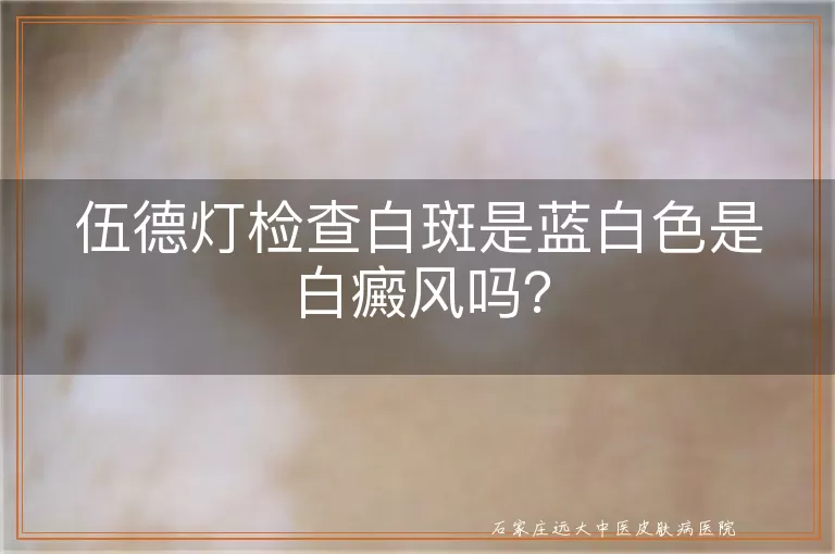 伍德灯检查白斑是蓝白色是白癜风吗？