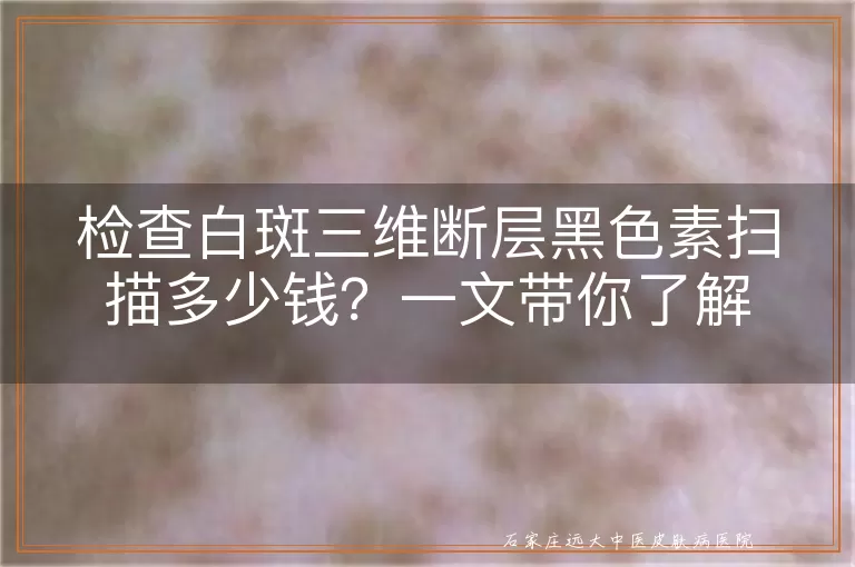 检查白斑三维断层黑色素扫描多少钱？一文带你了解