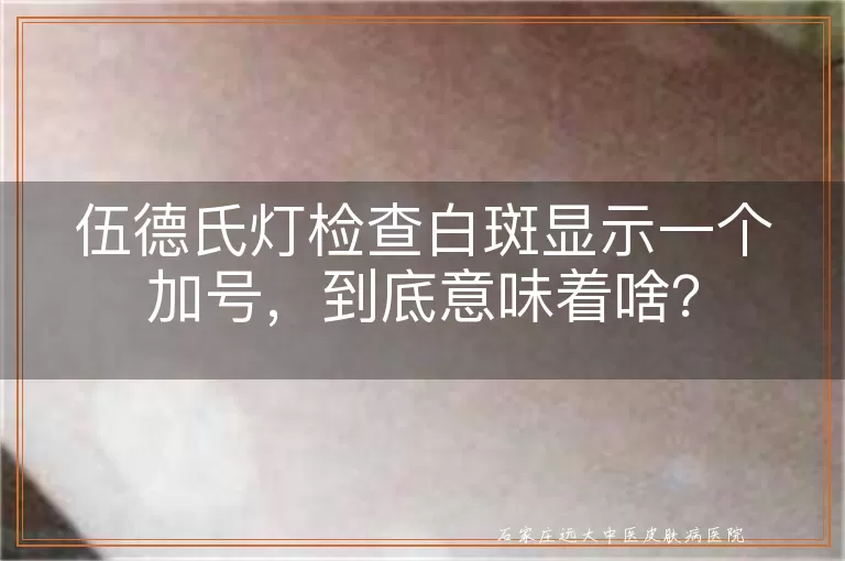 伍德氏灯检查白斑显示一个加号，到底意味着啥？