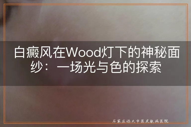 白癜风在Wood灯下的神秘面纱：一场光与色的探索