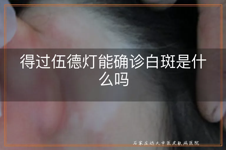得过伍德灯能确诊白斑是什么吗