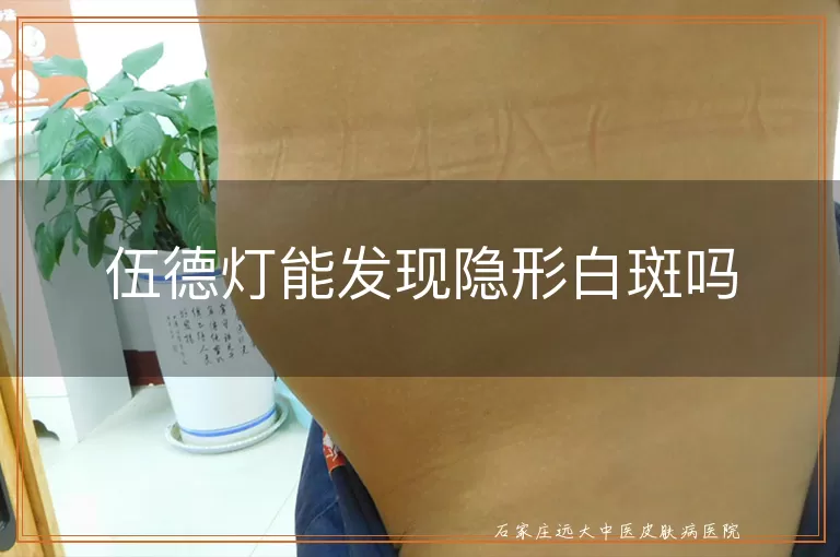 伍德灯能发现隐形白斑吗
