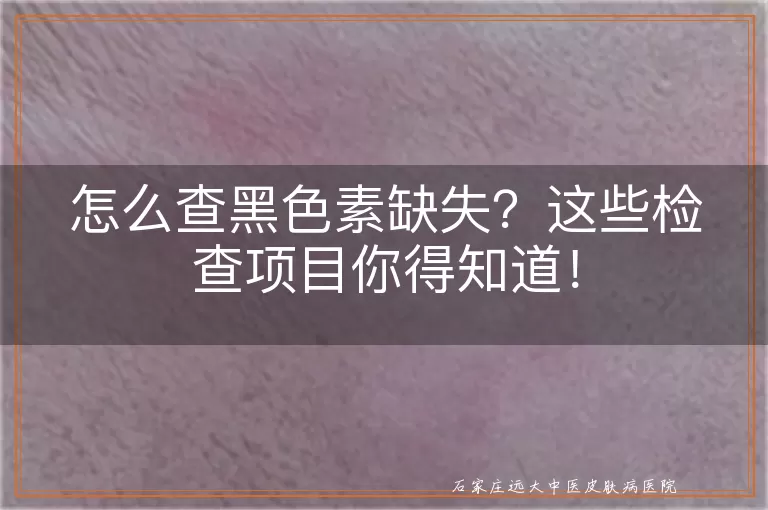 怎么查黑色素缺失？这些检查项目你得知道！