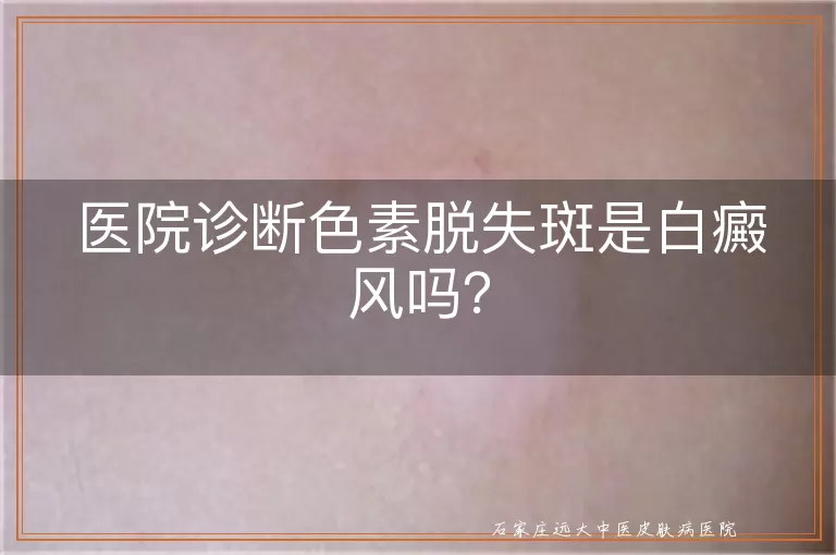 医院诊断色素脱失斑是白癜风吗？
