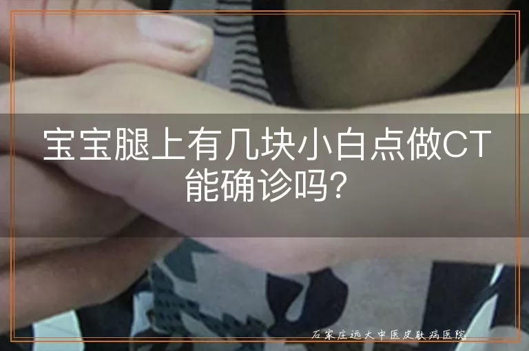宝宝腿上有几块小白点做CT能确诊吗？