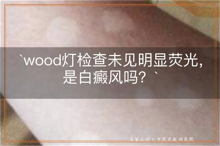 wood灯检查未见明显荧光，是白癜风吗？