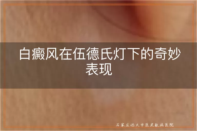 白癜风在伍德氏灯下的奇妙表现