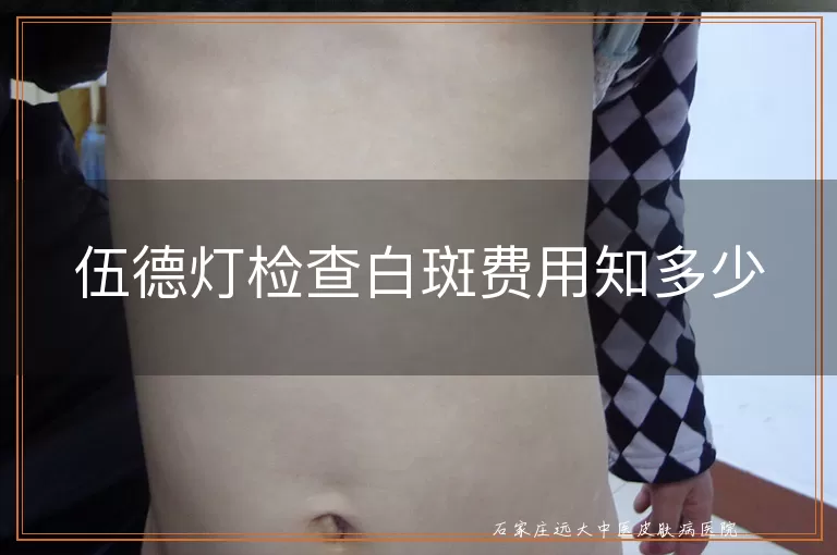 伍德灯检查白斑费用知多少