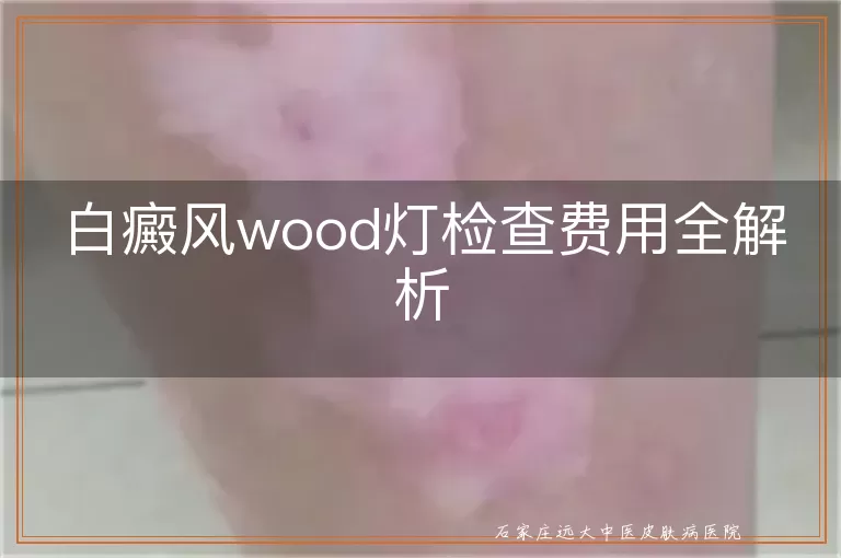 白癜风wood灯检查费用全解析