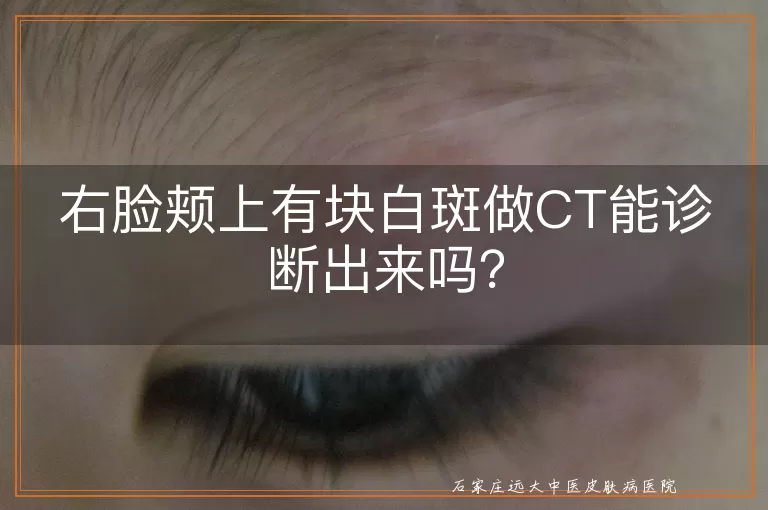 右脸颊上有块白斑做CT能诊断出来吗？