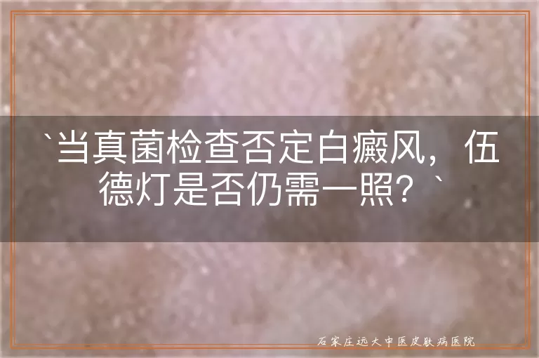 当真菌检查否定白癜风，伍德灯是否仍需一照？