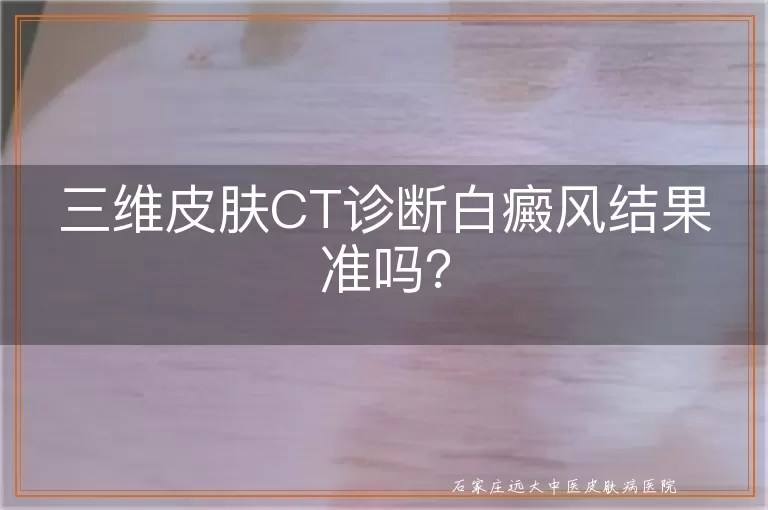 三维皮肤CT诊断白癜风结果准吗？