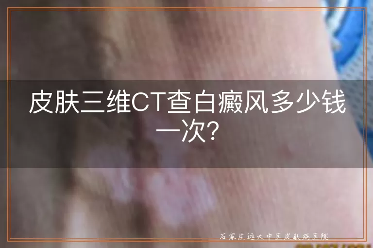 皮肤三维CT查白癜风多少钱一次？