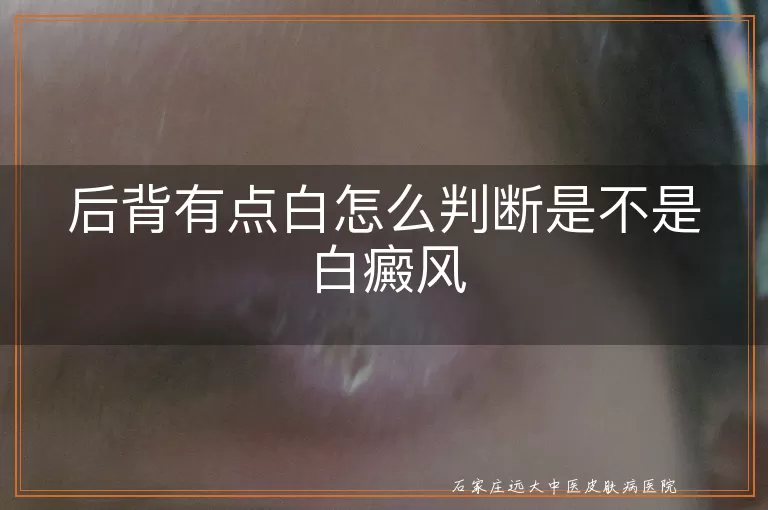 后背有点白怎么判断是不是白癜风