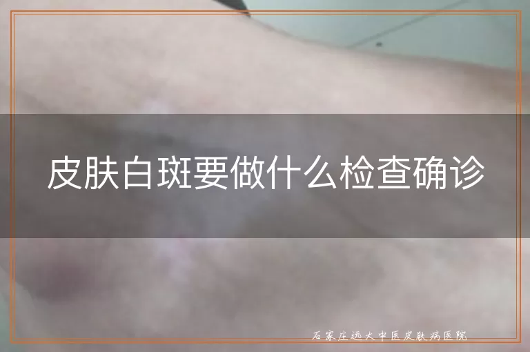 皮肤白斑要做什么检查确诊