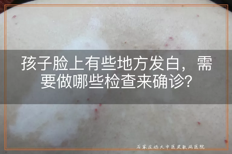 孩子脸上有些地方发白，需要做哪些检查来确诊？