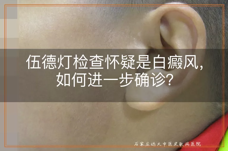 伍德灯检查怀疑是白癜风，如何进一步确诊？
