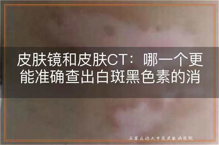 皮肤镜和皮肤CT：哪一个更能准确查出白斑黑色素的消失？