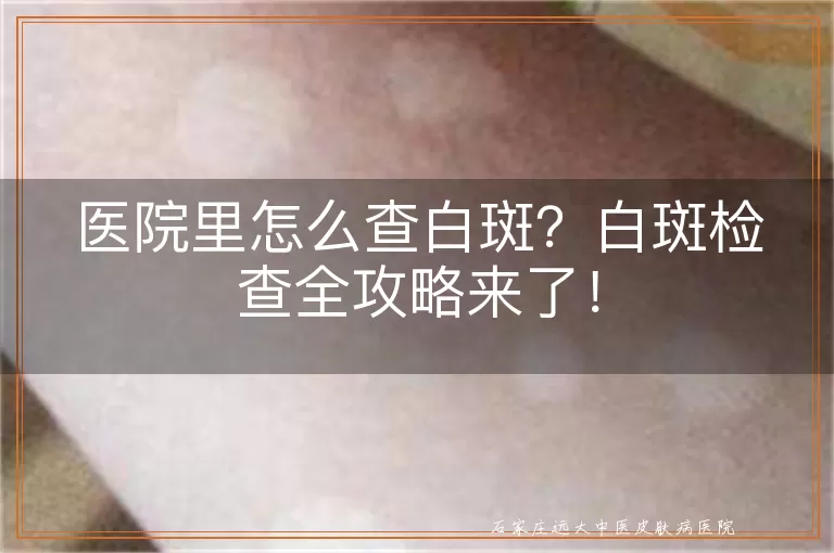 医院里怎么查白斑？白斑检查全攻略来了！
