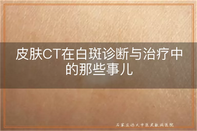 皮肤CT在白斑诊断与治疗中的那些事儿